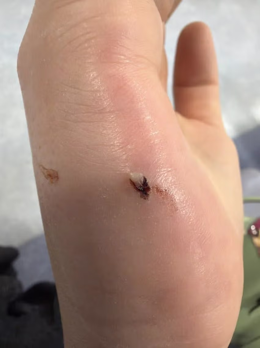 (혐주의)고양이 물림사고의 위험성 2