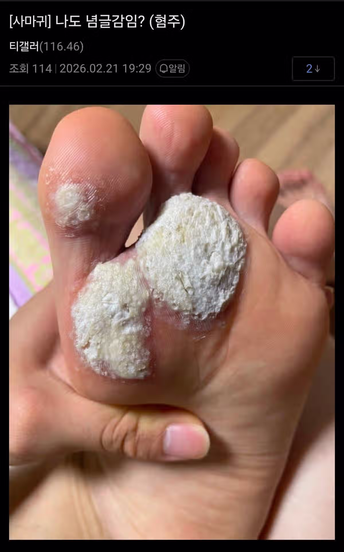 극혐) 티눈갤 근황 4