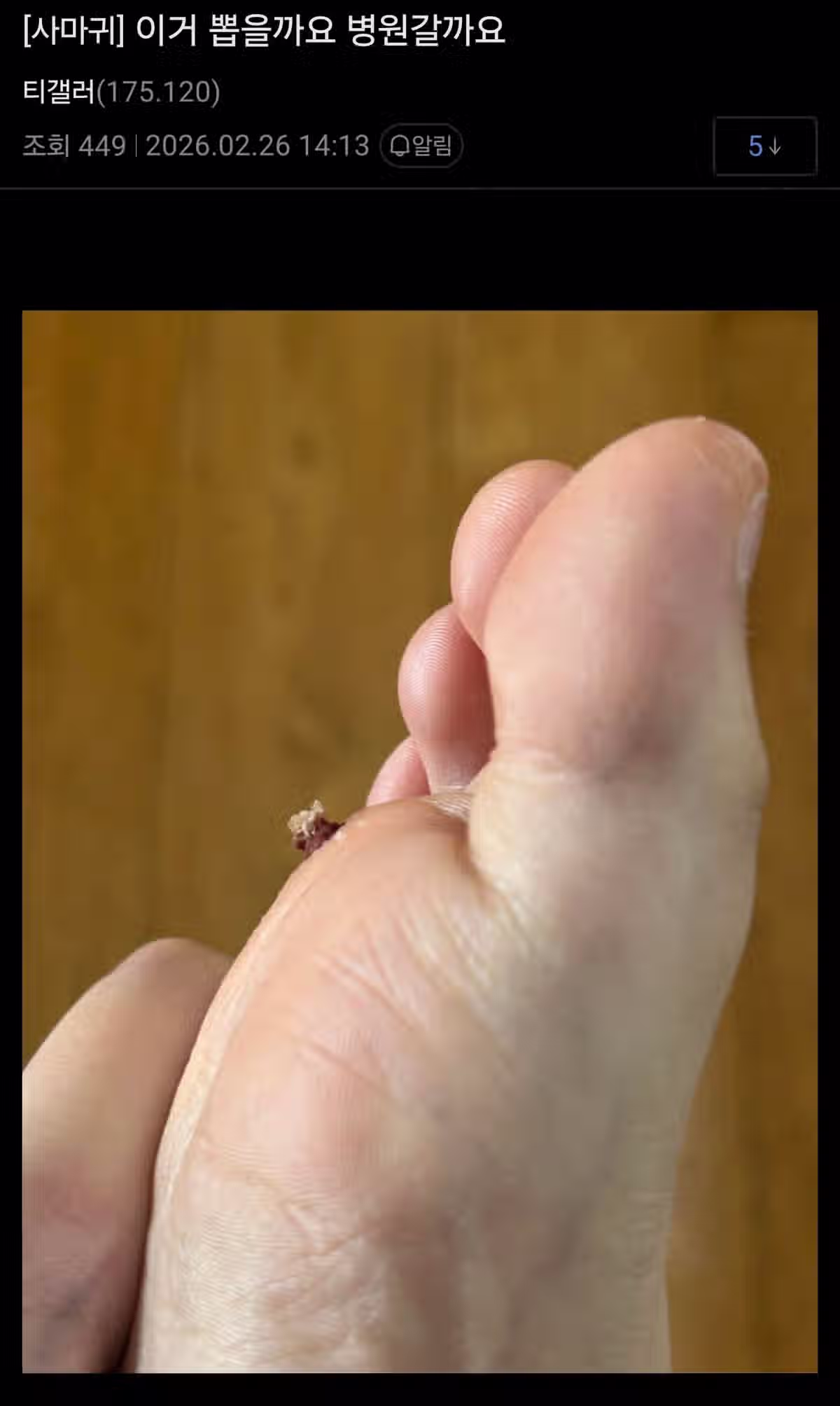 극혐) 티눈갤 근황 3