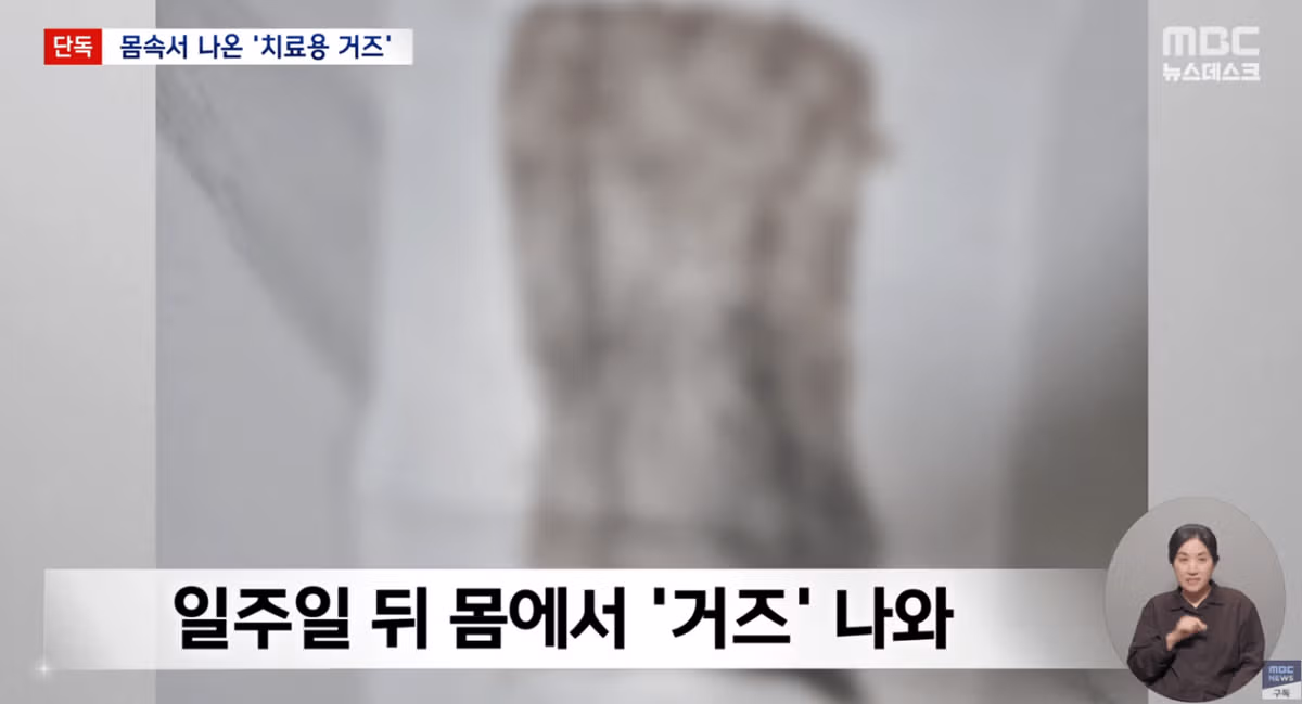 생리하다가 나온 손바닥만한 '치료용 거즈' - 밈카세