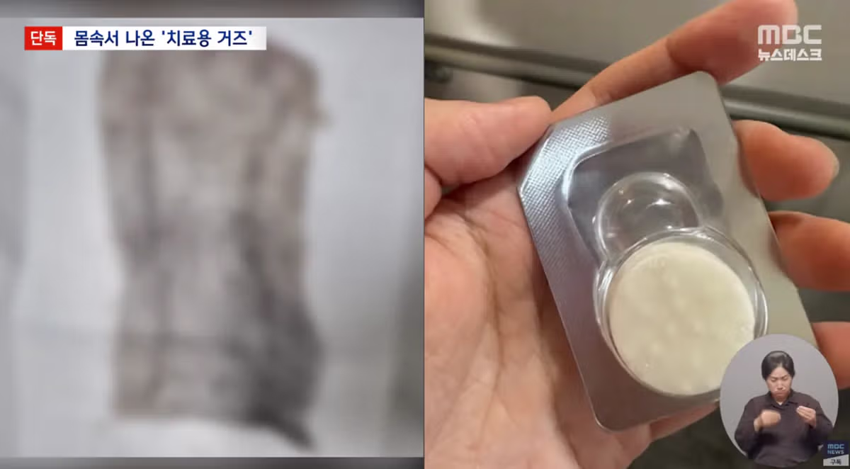 생리하다가 나온 손바닥만한 '치료용 거즈' - 밈카세