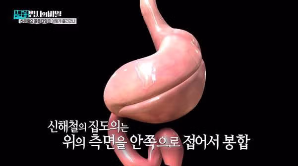 본인 동의 없이 위 축소술 받았다는 신해철.jpg - 밈카세