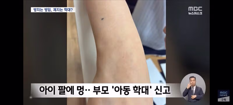 말리다가 생긴 멍이 아동학대로 인정된 사례와 교육계 반응 - 클리앙 인기글 이미지 8 - 밈카세