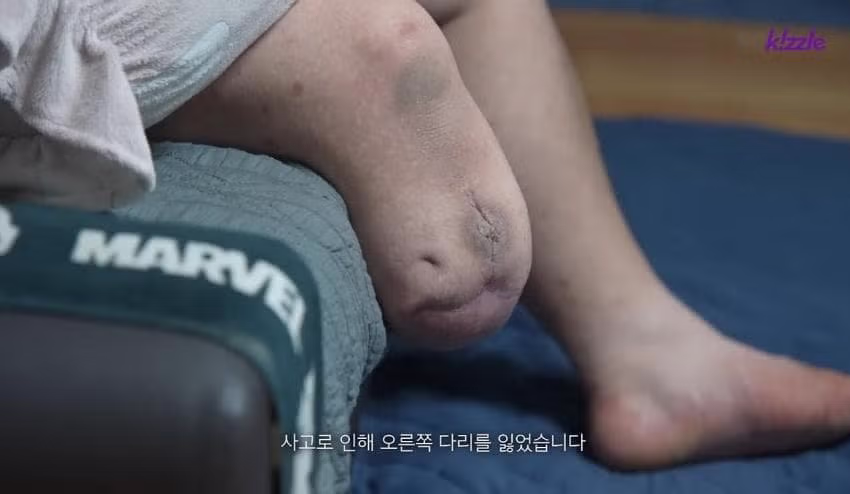 조선소 사고로 다리를 잃은 청년의 사연 - 인벤 인기글 이미지 4 - 밈카세
