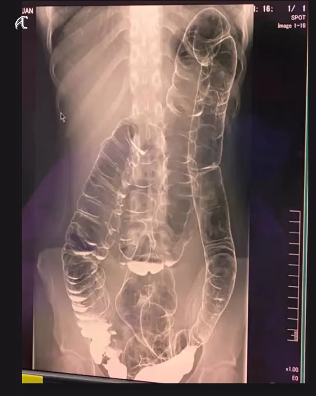 17일간 변비로 화장실 못 간 여성의 엑스레이 사진