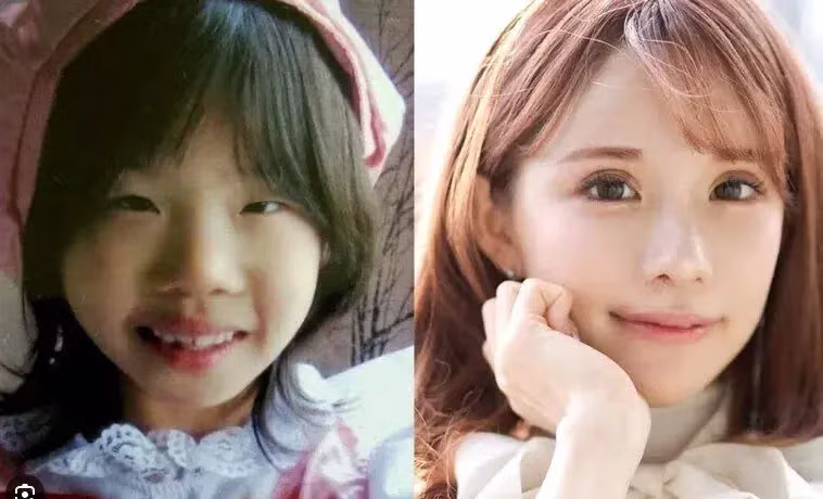 19살부터 2억원 규모로 성형한 츠자 - 개드립 인기글 이미지 3 - 밈카세