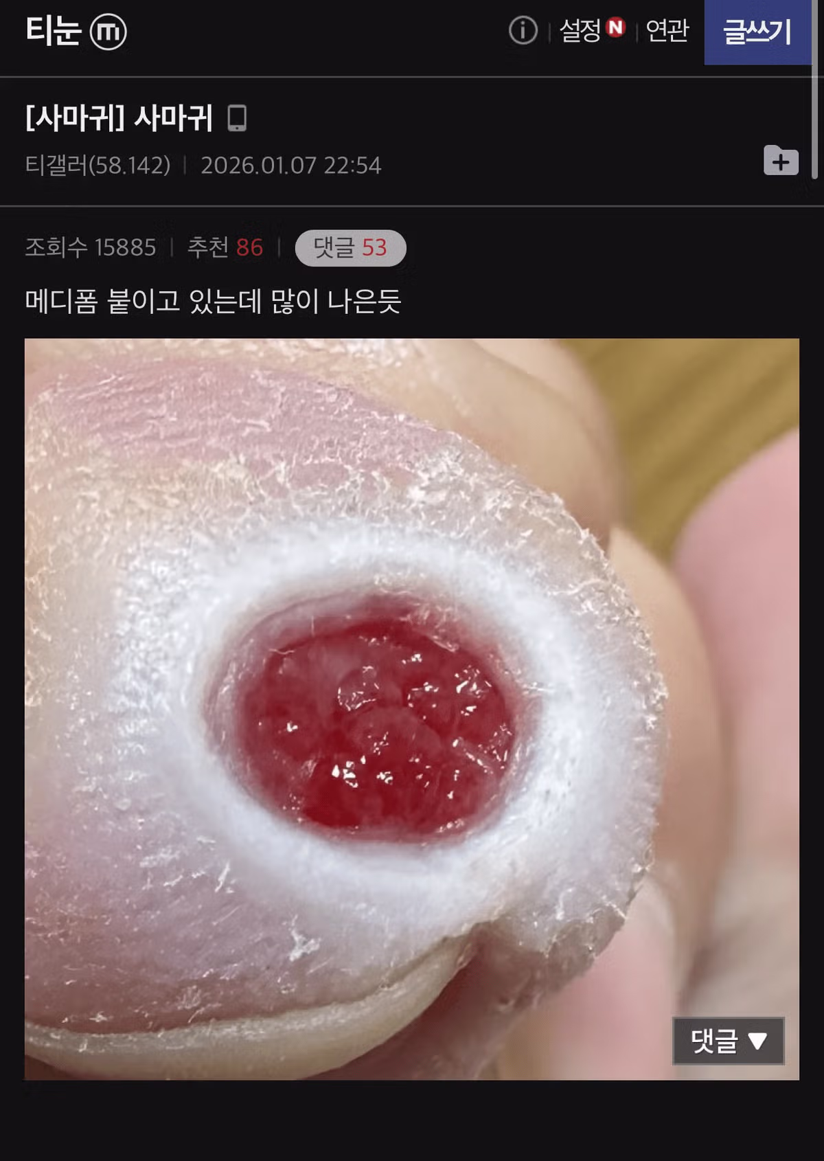 티눈 갤러리 칠성장어 친구의 충격적인 근황 - FM코리아 인기글 이미지 2 - 밈카세