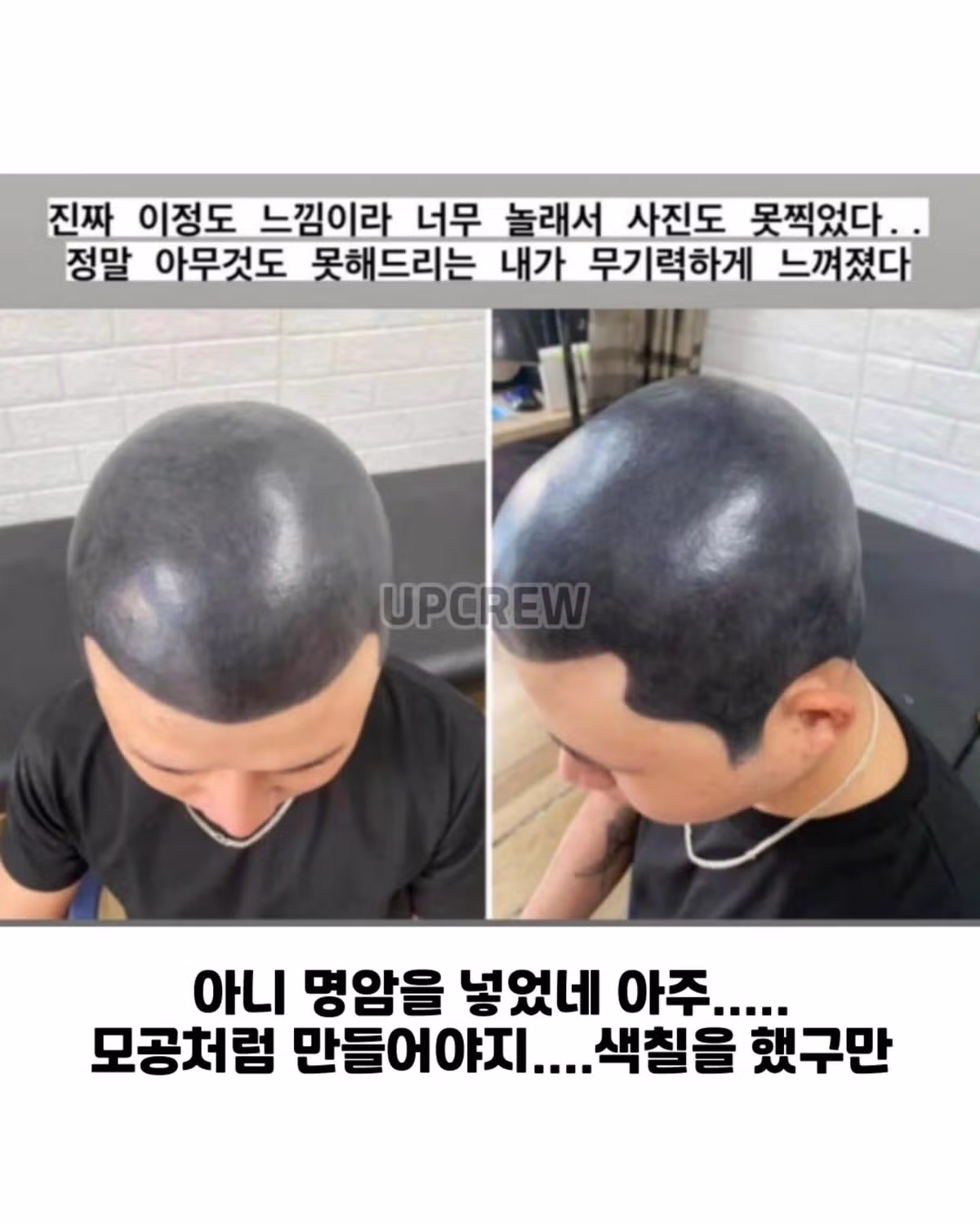 두피문신 실패해서 끔찍한 결과가 된 사례 - 디시인사이드 인기글 이미지 1 - 밈카세