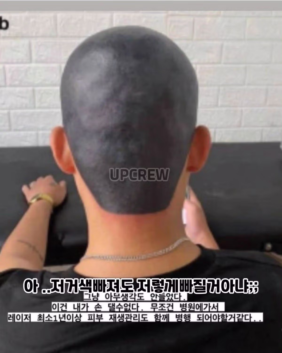 두피문신 실패해서 끔찍한 결과가 된 사례 - 디시인사이드 인기글 이미지 2 - 밈카세
