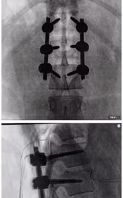 여태껏 허리 수술 3번 받은 최가온 선수 2