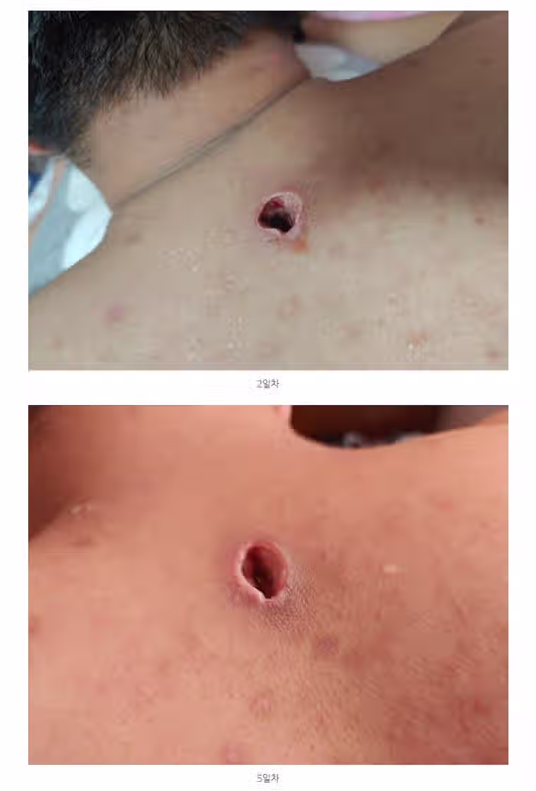 (혐) 옛 시절 사람 많이 죽였다는 등창 2