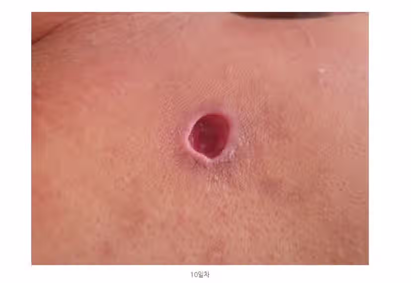 (혐) 옛 시절 사람 많이 죽였다는 등창 3