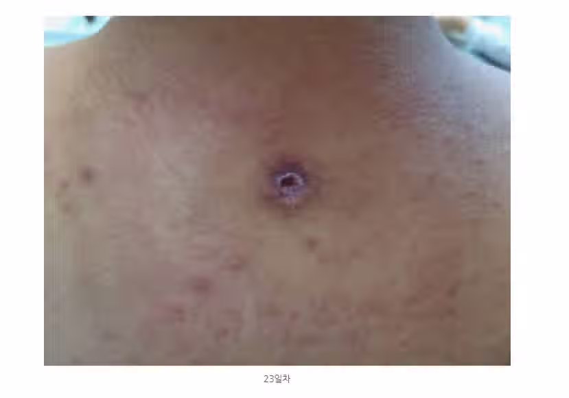 (혐) 옛 시절 사람 많이 죽였다는 등창 5