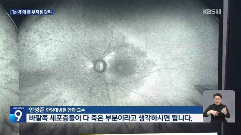 kbs) 류마티스 약 먹다 시력 손상..."검사 필수" - 디시인사이드 인기글 이미지 4 - 밈카세