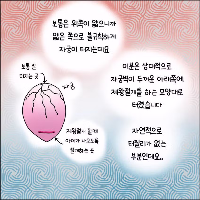 출산 중 자궁파열된 썰 - 와이고수 인기글 이미지 8 - 밈카세