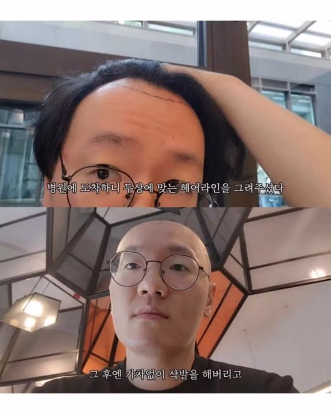 튀르키예까지 가서 모발이식 받으려다 삭발한 썰 - 인벤 인기글 이미지 2 - 밈카세