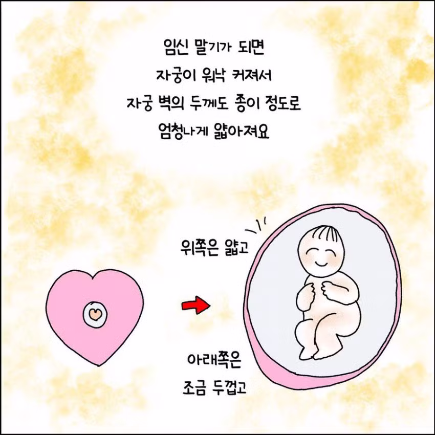 출산 중 자궁파열된 썰 - 와이고수 인기글 이미지 2 - 밈카세