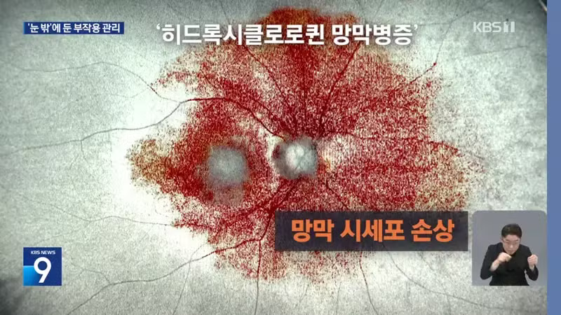 kbs) 류마티스 약 먹다 시력 손상..."검사 필수" - 디시인사이드 인기글 이미지 3 - 밈카세