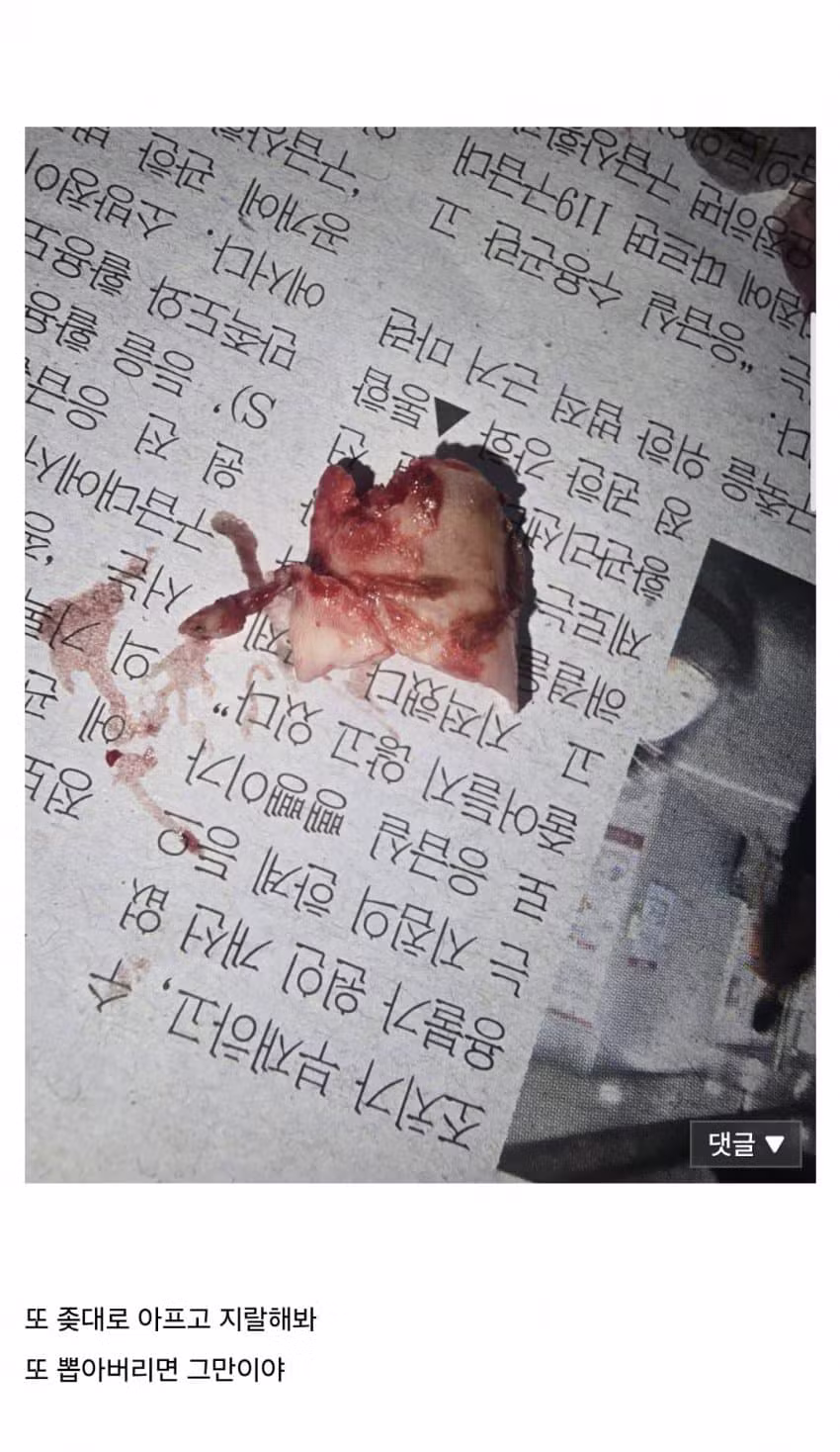 셀프로 발톱 뽑는 광기 - 인벤 인기글 이미지 5 - 밈카세