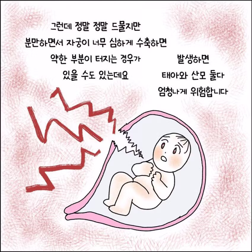 출산 중 자궁파열된 썰 - 와이고수 인기글 이미지 3 - 밈카세