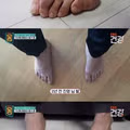 통풍으로 고통받는 남성 환자의 발 상태