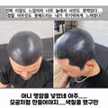 두피문신 실패해서 끔찍한 결과가 된 사례